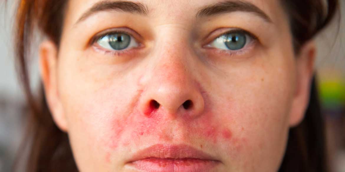 Periorale Dermatitis