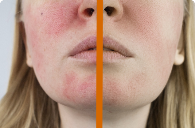 Rosacea Verstehen und Natürlich Behandeln: Ein Leitfaden