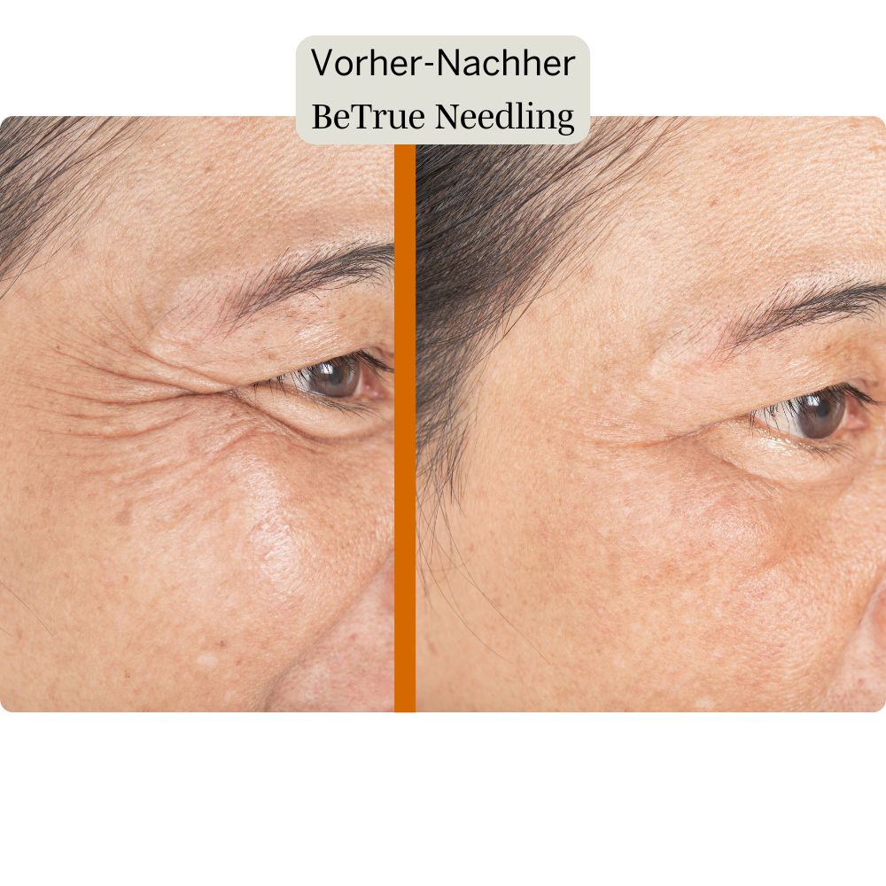 Better Aging Needling Komplettset für Zuhause