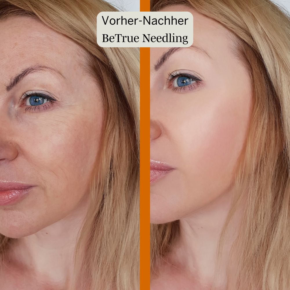 Better Aging Needling Komplettset für Zuhause