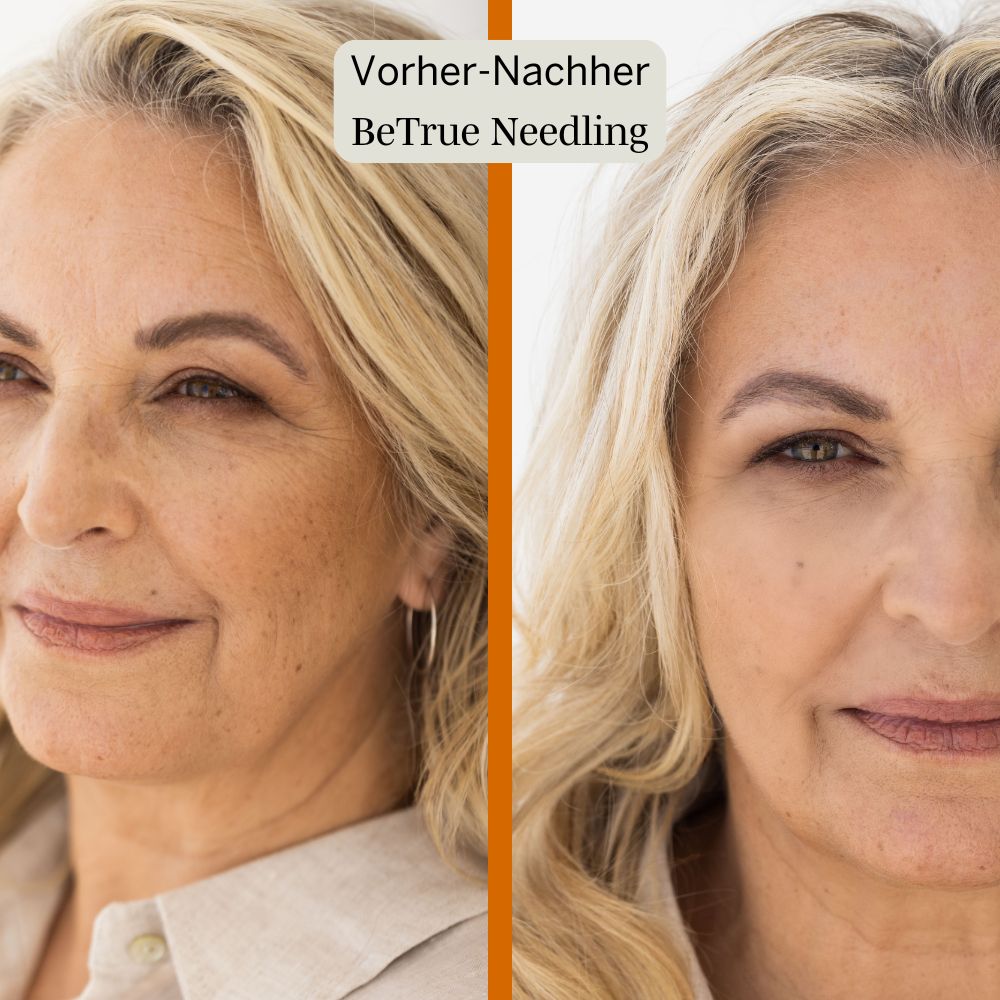 Better Aging Needling Komplettset für Zuhause